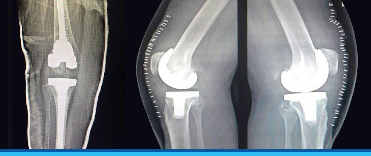 Total Knee Replacement | Hip Replacement in Bangalore