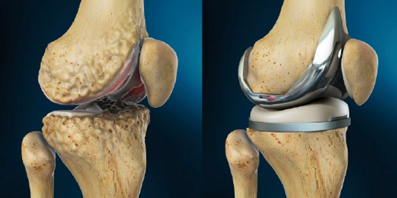 Facts-About-Total-Knee-Replacement-You-Must-Know
