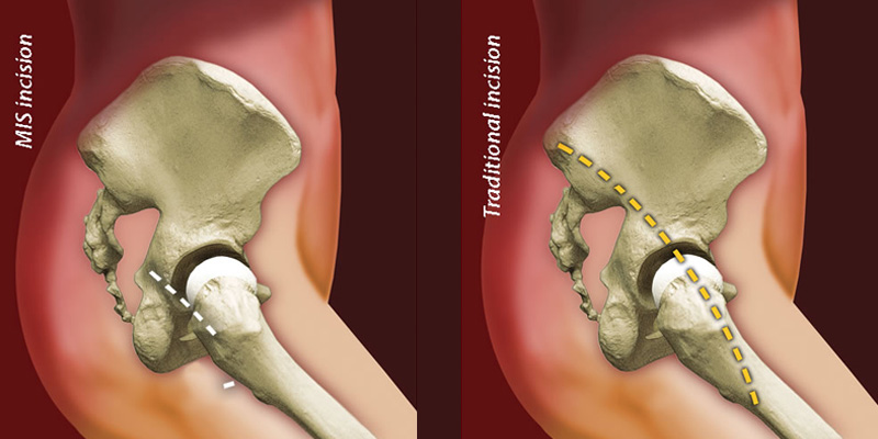 How Do Traditional And Minimally Invasive Hip Replacements Differ