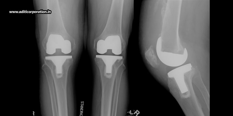 Things-To-Take-Care-Of-When-You-Undergo-Bilateral-Total-Knee-Arthroplasty
