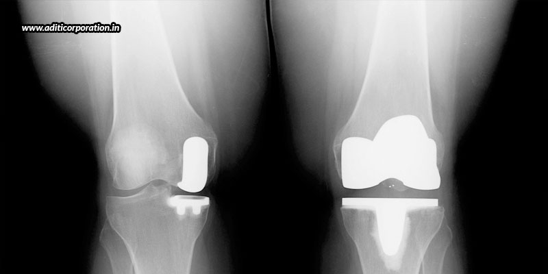 Partial-Or-Total-Knee-Replacement-–-What-Should-You-Choose