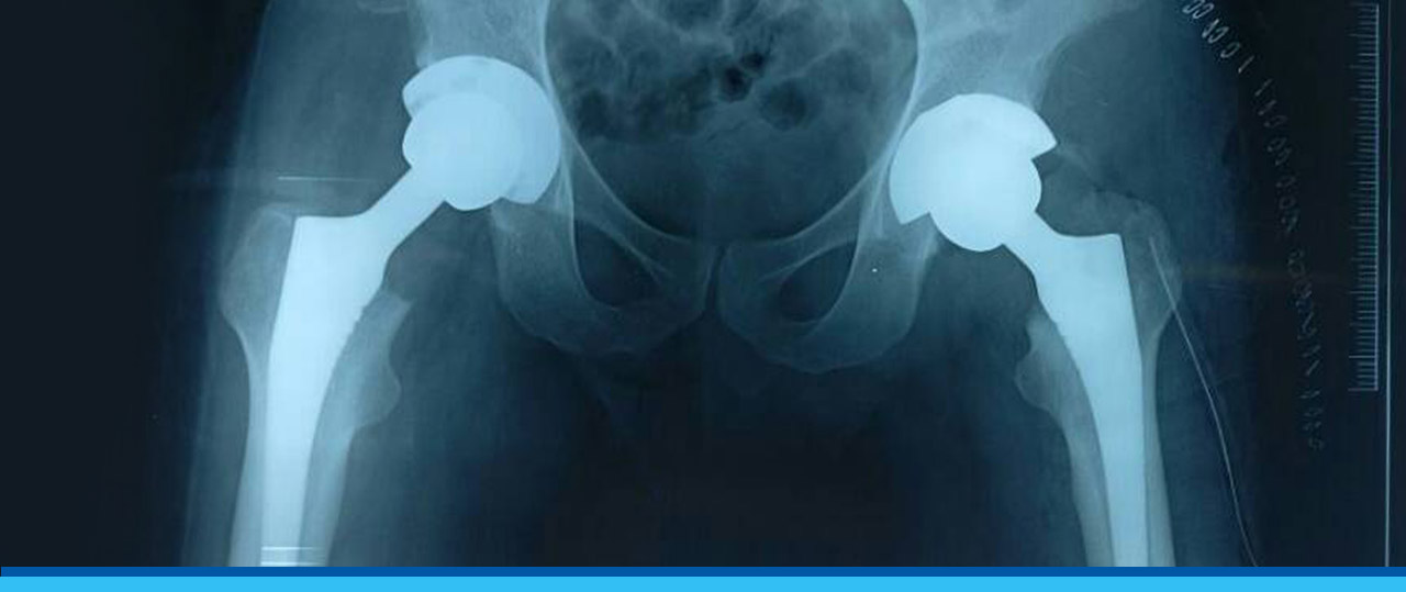 Total HIP and Knee Replacement in Bangalore
