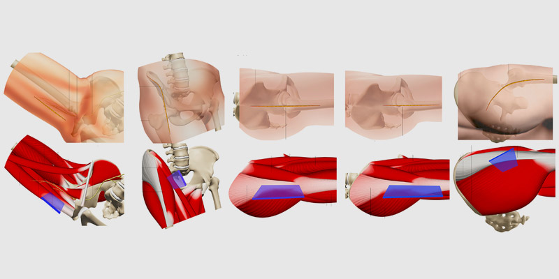 Which-Are-The-Different-Hip-Replacement-Approaches