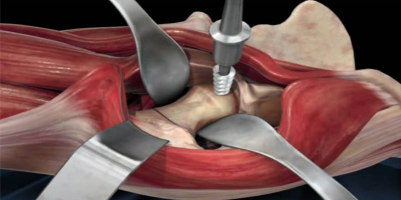 anterior hip replacement