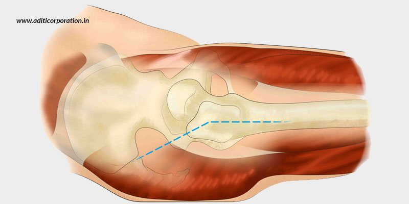 Is-It-Beneficial-To-Opt-For-An-Anterior-Hip-Replacement